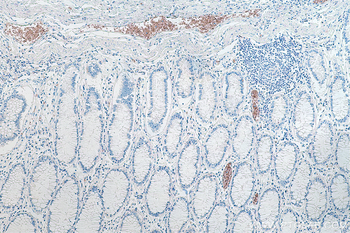 IHC staining of human colon cancer using 67014-1-Ig