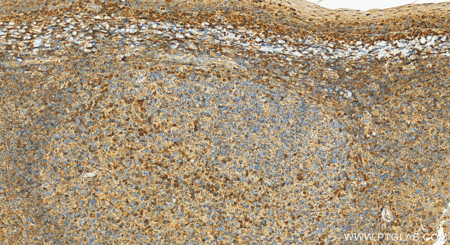 IHC staining of human tonsillitis using 13338-1-AP