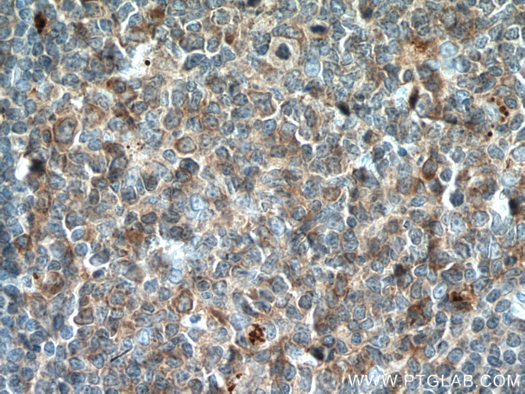 IHC staining of human tonsillitis using 14922-1-AP