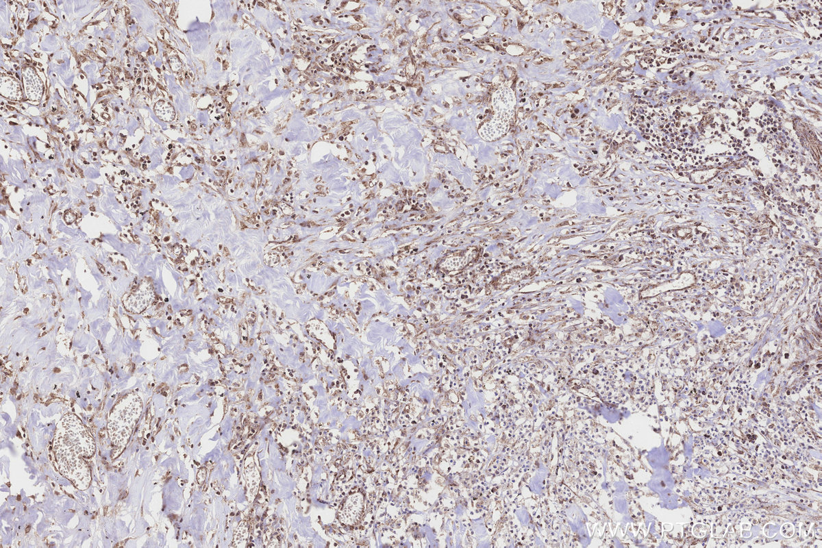 IHC staining of human colon cancer using 10403-1-AP IHC staining of human colon cancer using 10403-1-AP