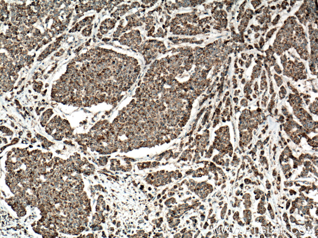 IHC staining of human colon cancer using 15932-1-AP