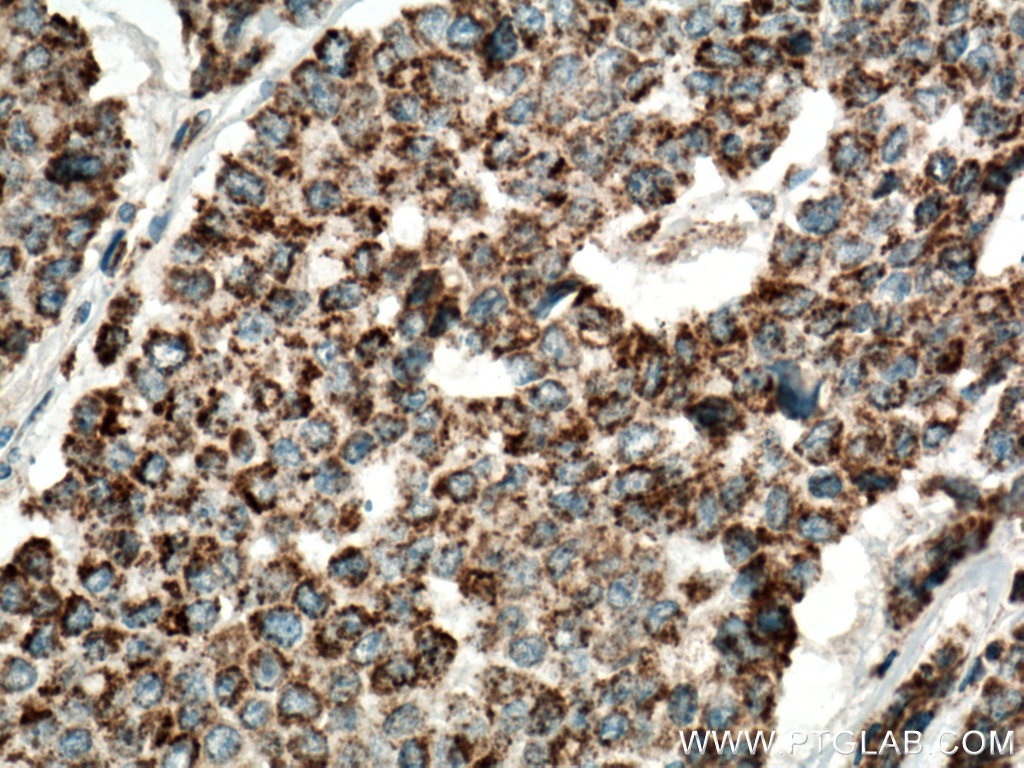 IHC staining of human colon cancer using 15932-1-AP