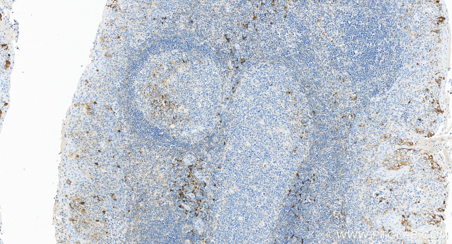 IHC staining of human tonsillitis using 84063-3-RR (same clone as 84063-3-PBS)