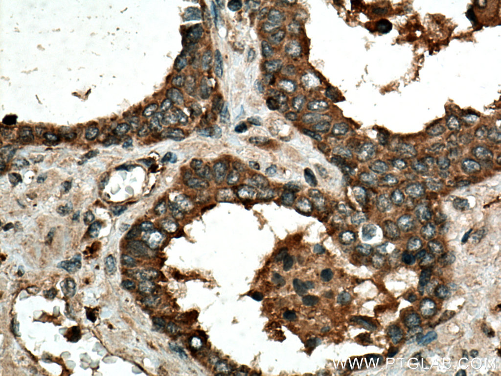 IHC staining of human prostate cancer using 55158-1-AP