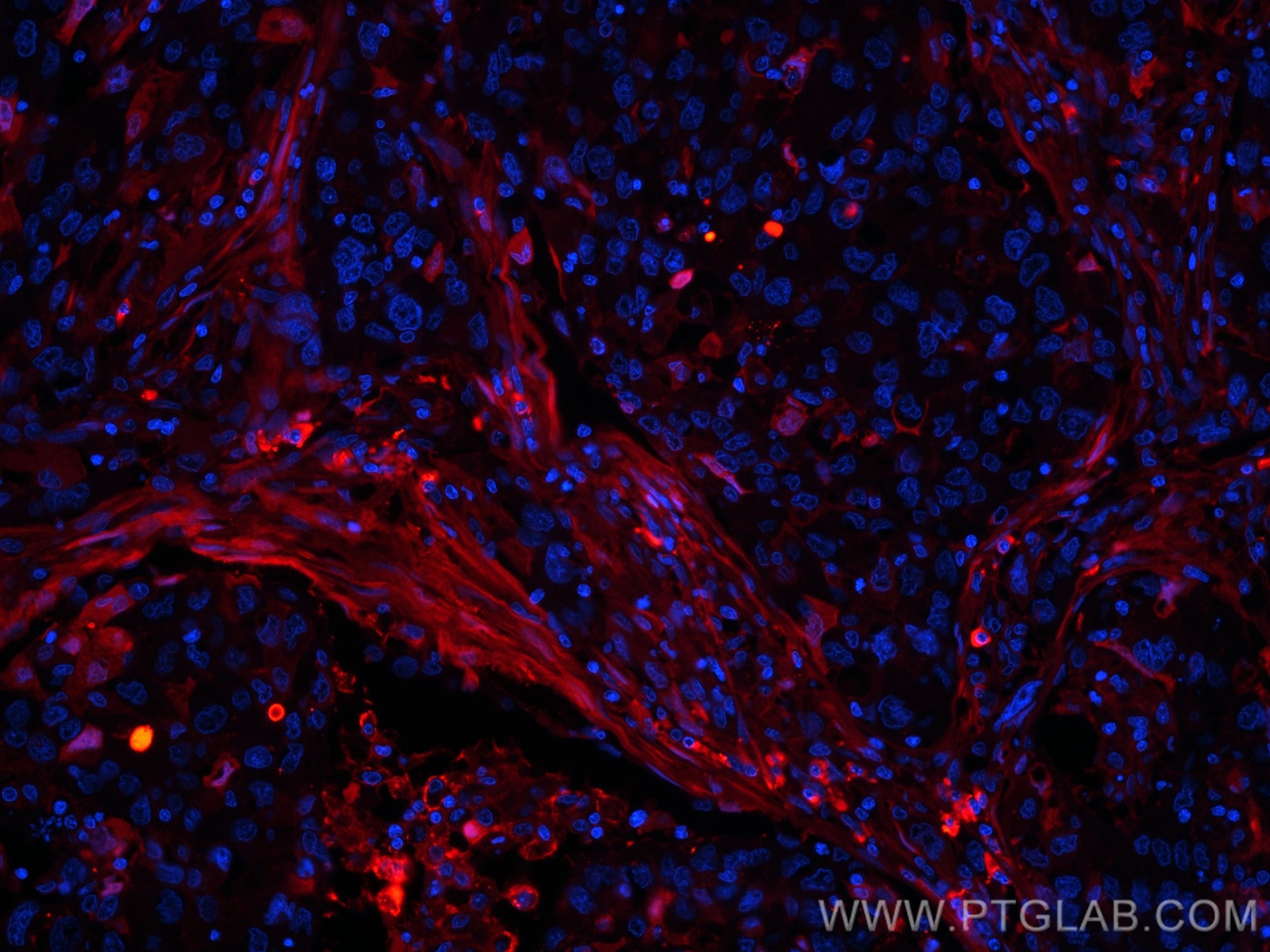 Immunofluorescent analysis of (4% PFA) fixed human lung cancer using FlexAble Biotin Antibody Labeling Kits for Human IgG and Streptavidin-594(red) to label endogenous human IgG in the tissue.