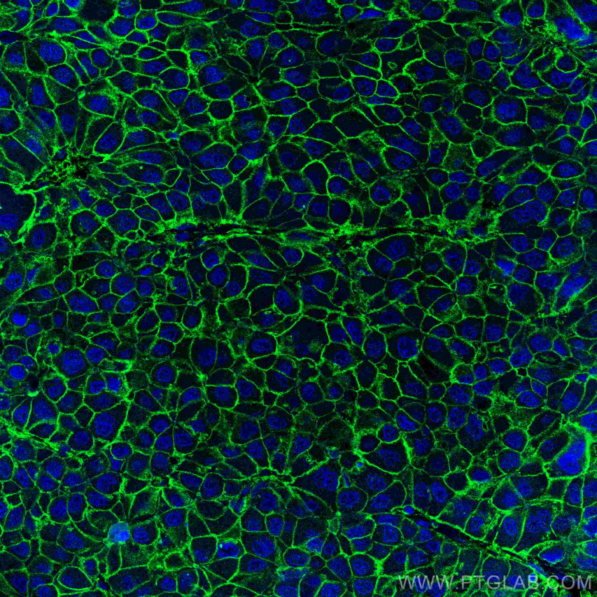 Immunofluorescent analysis of (4% PFA) fixed human liver cancer tissue using 67221-1-Ig (SLC31A1 antibody) at dilution of 1:100 and CoraLite488-Conjugated AffiniPure Goat Anti-Mouse IgG(H+L).