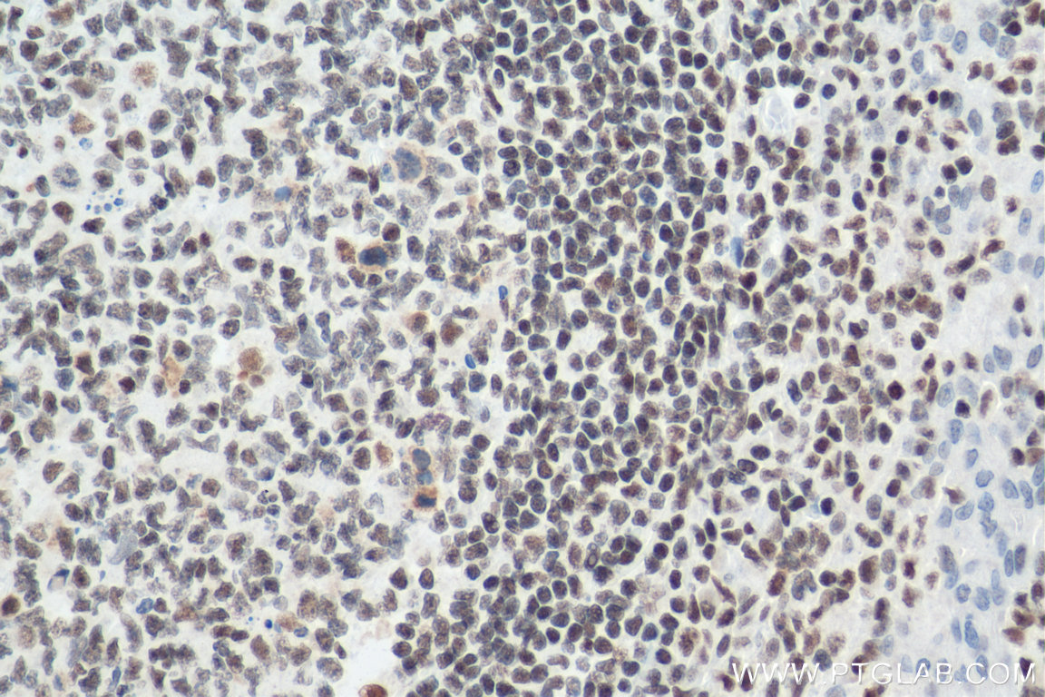 IHC staining of human tonsillitis using 67790-1-Ig
