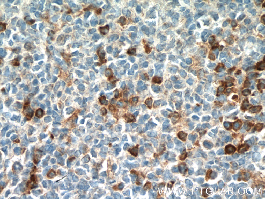 IHC staining of human tonsillitis using 27233-1-AP