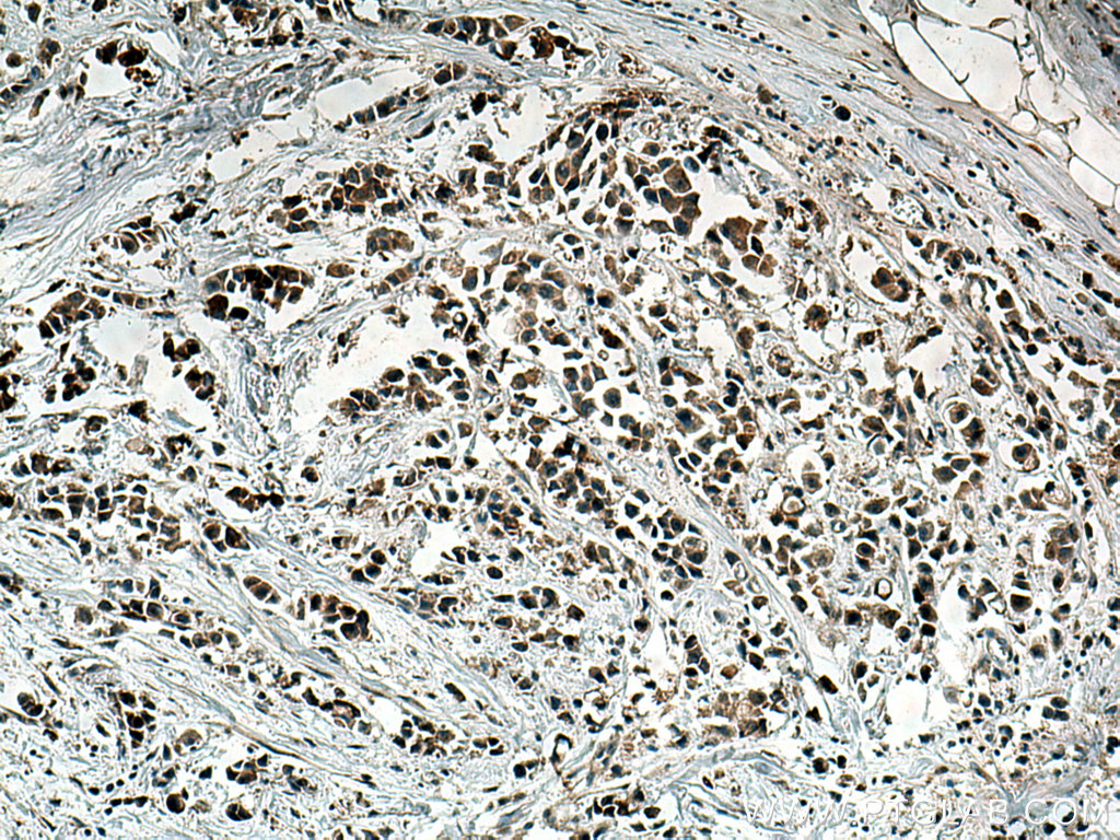 IHC staining of human breast cancer using 11246-1-AP