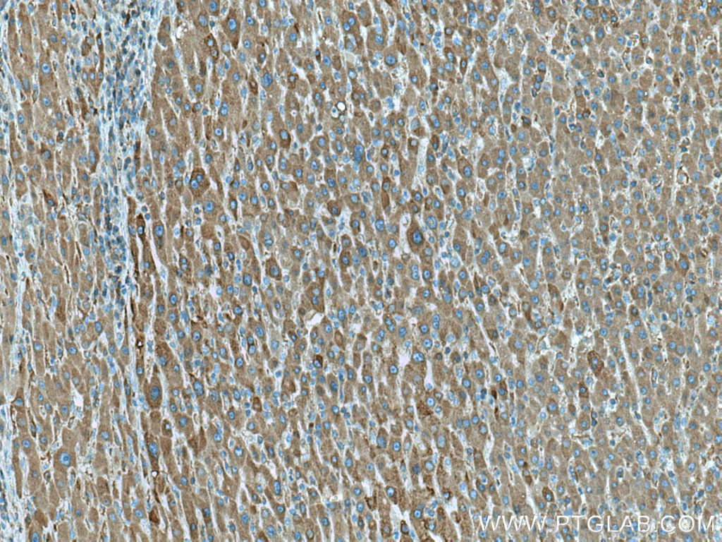 IHC staining of human liver cancer using 66770-1-Ig