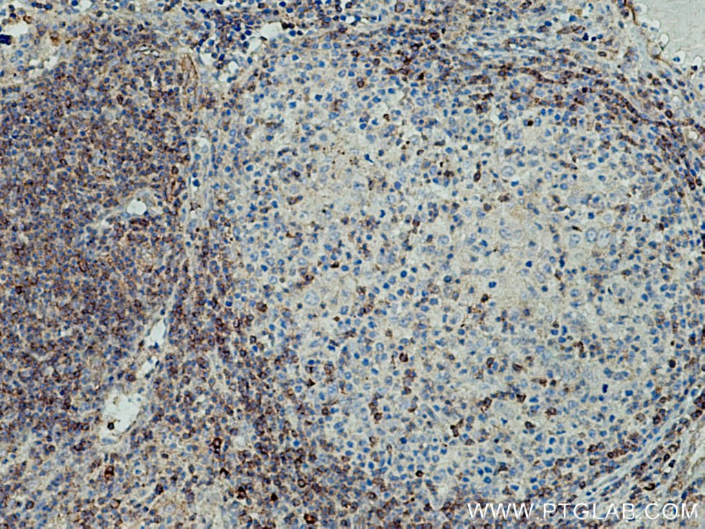 IHC staining of human lymphoma using 11727-3-AP