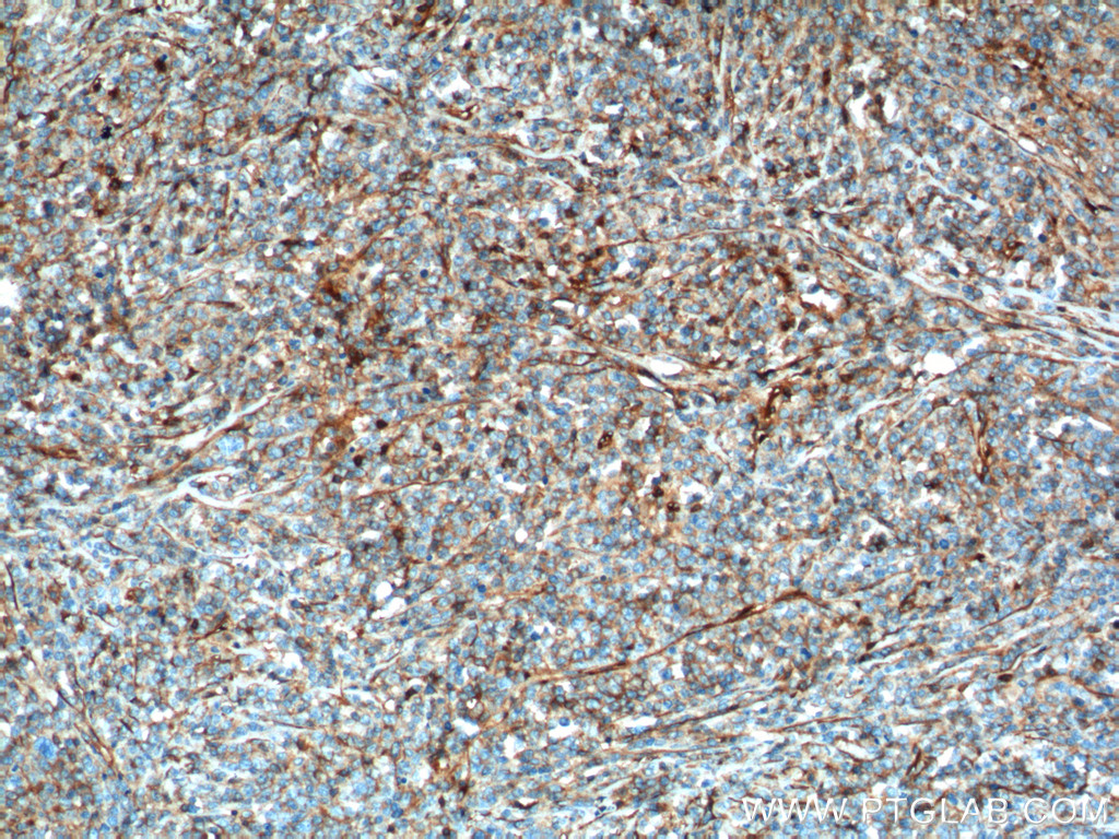 IHC staining of human lymphoma using 60074-1-Ig