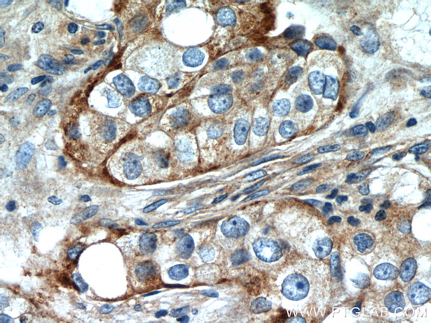 IHC staining of human breast cancer using 12769-1-AP