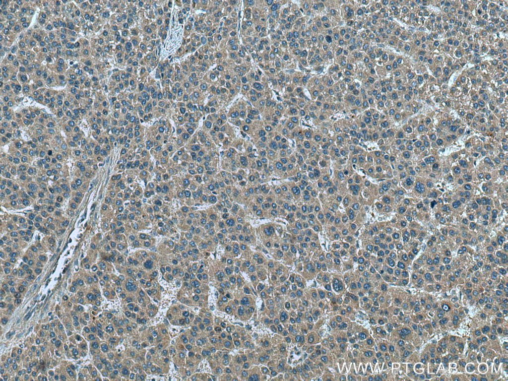 IHC staining of human liver cancer using 66081-1-Ig