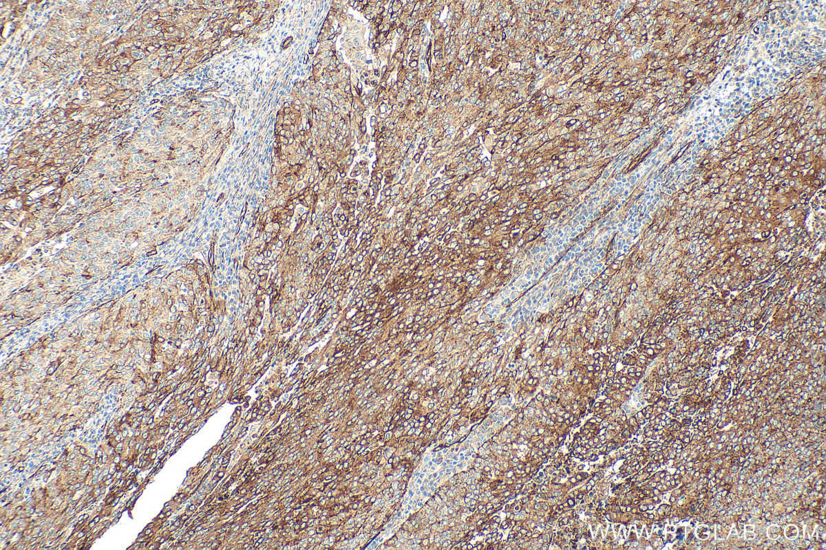 IHC staining of human ovary tumor using RMX00071 IHC staining of human ovary tumor using RMX00071