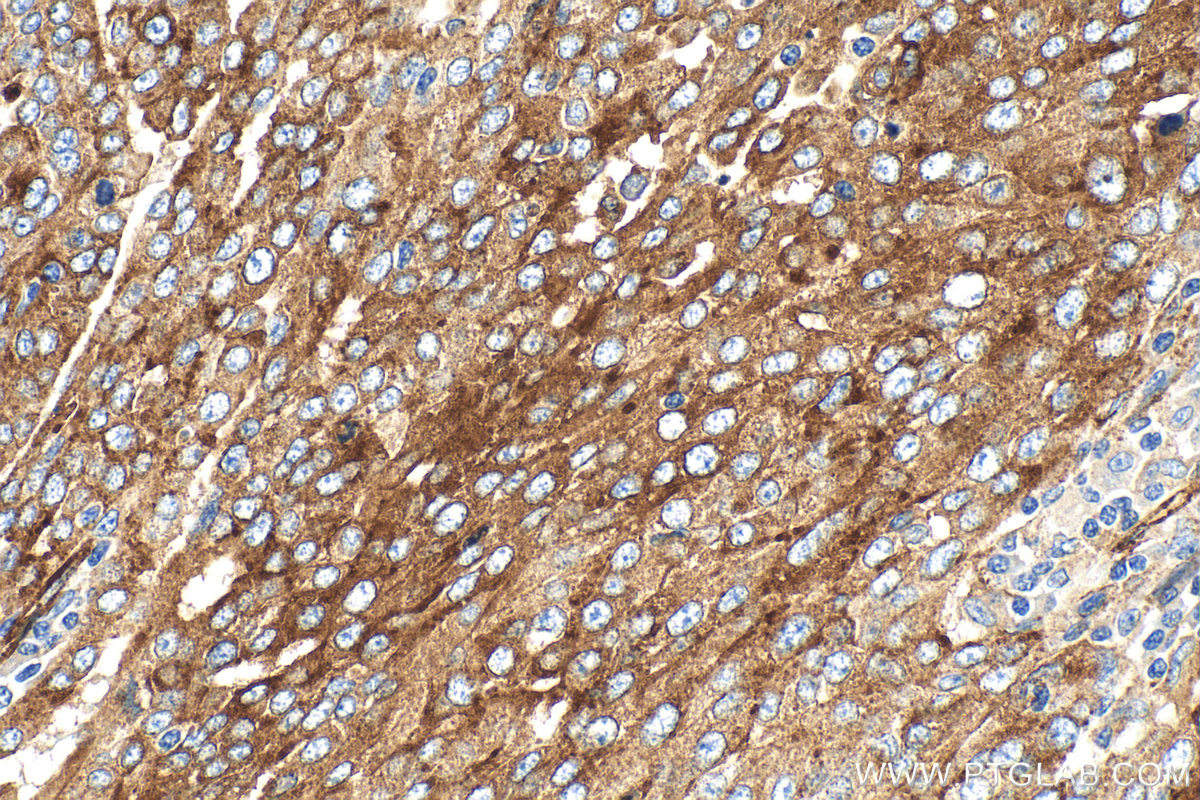 IHC staining of human ovary tumor using RMX00071 IHC staining of human ovary tumor using RMX00071