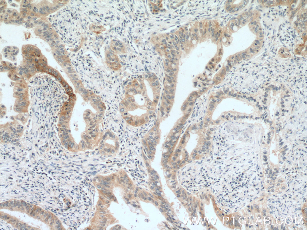 IHC staining of human pancreas cancer using 10808-1-AP