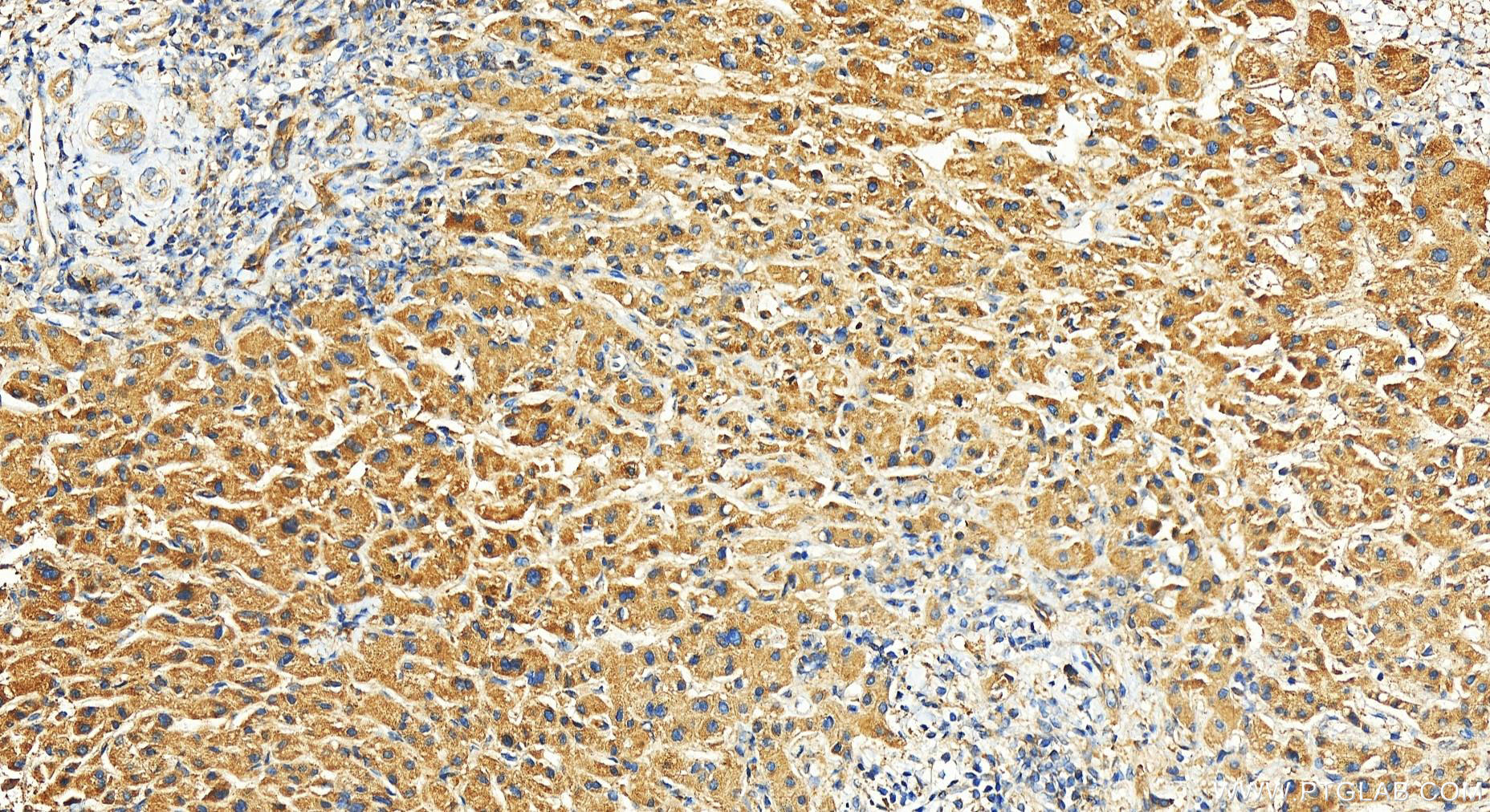 IHC staining of human intrahepatic cholangiocarcinoma using 12939-1-AP (same clone as 12939-1-PBS)
