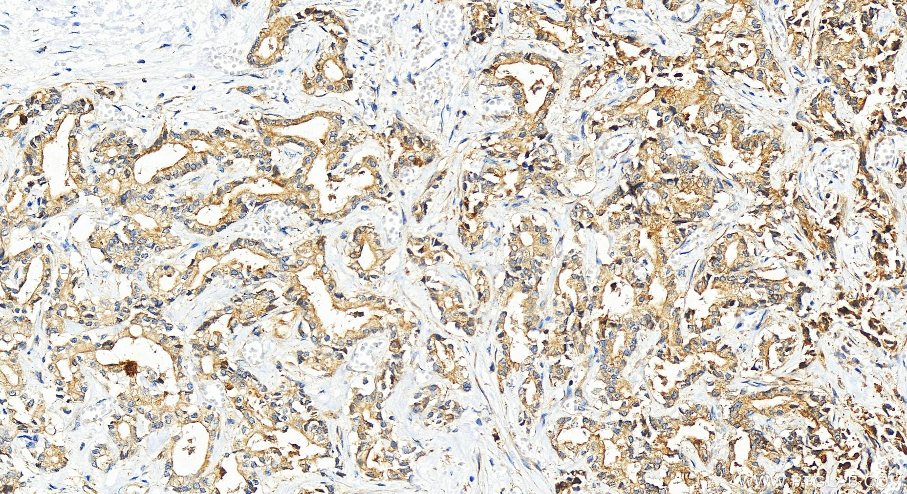 IHC staining of human intrahepatic cholangiocarcinoma using 12939-1-AP (same clone as 12939-1-PBS)