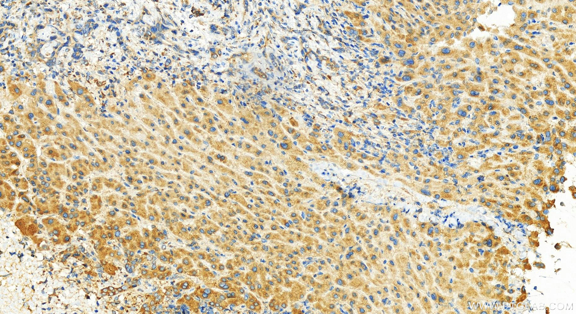 IHC staining of human intrahepatic cholangiocarcinoma using 10649-1-AP