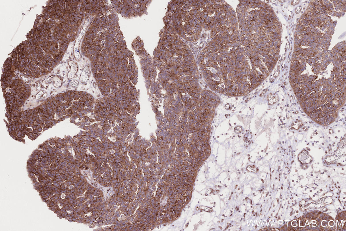 IHC staining of human ovary cancer using 13615-1-AP IHC staining of human ovary cancer using 13615-1-AP