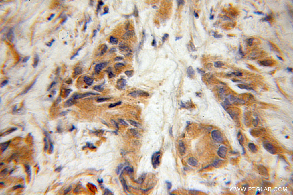 IHC staining of human prostate cancer using 11083-1-AP