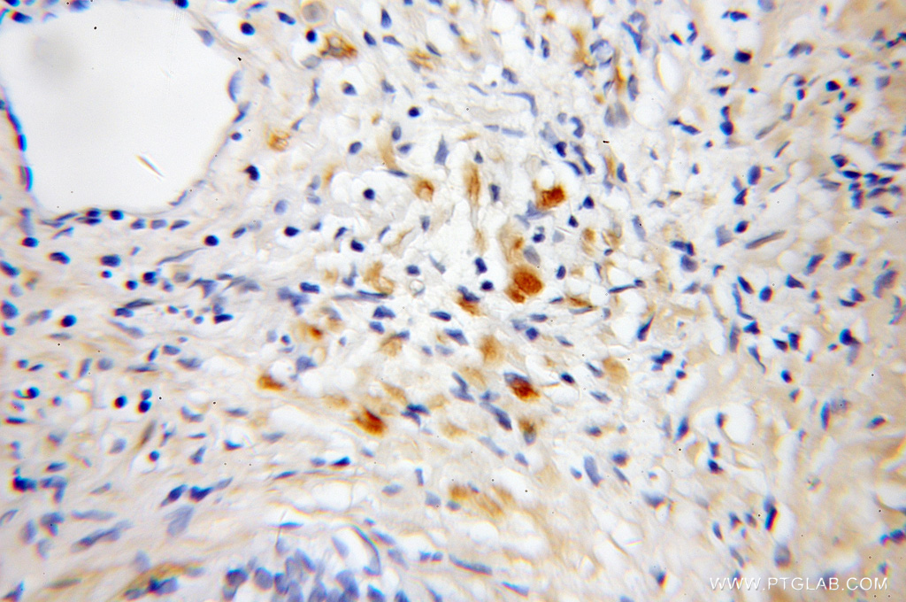 IHC staining of human prostate cancer using 11744-1-AP