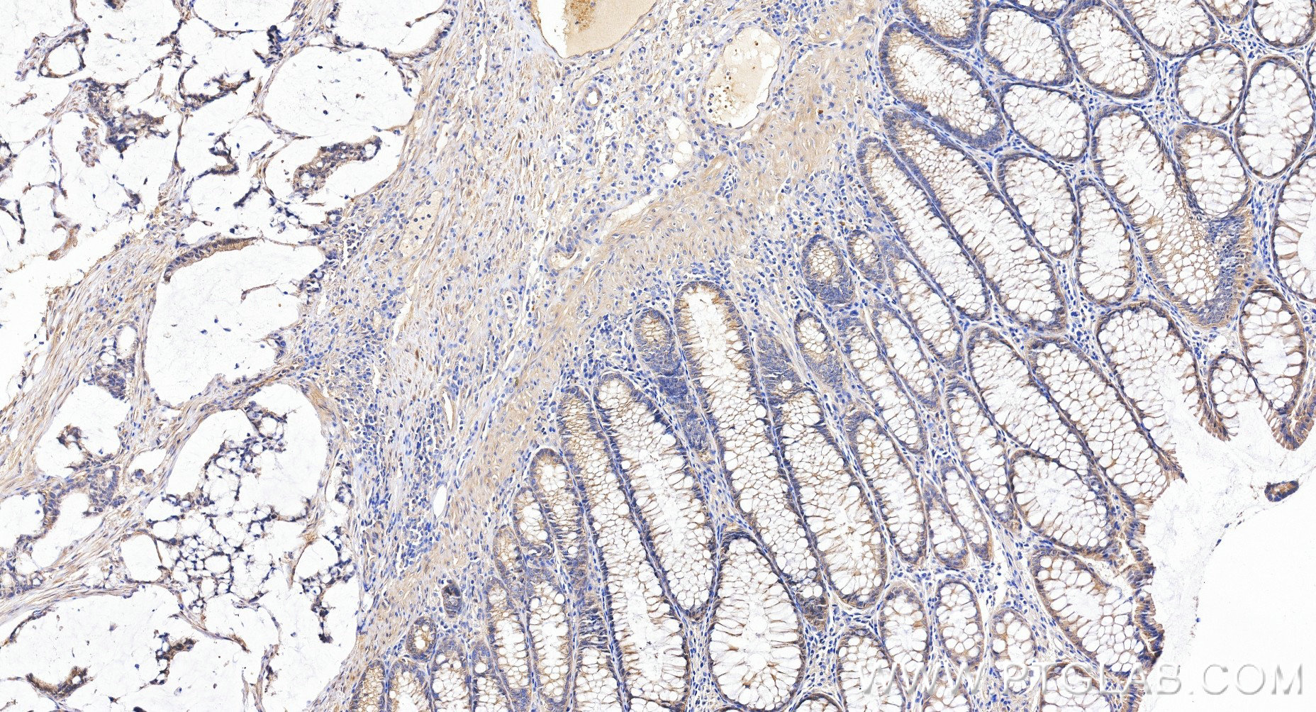 IHC staining of human colon cancer using 84385-3-RR