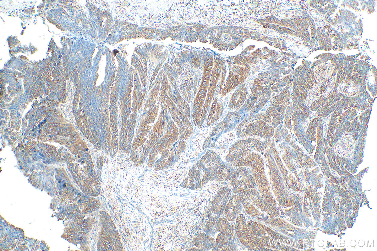 Immunohistochemical analysis of paraffin-embedded human colon cancer tissue slide using 14642-1-AP (IGF2BP3 antibody) at dilution of 1:1000 (under 10x lens). Heat mediated antigen retrieval with Tris-EDTA buffer (pH 9.0). IHC staining of human colon cancer using 14642-1-AP