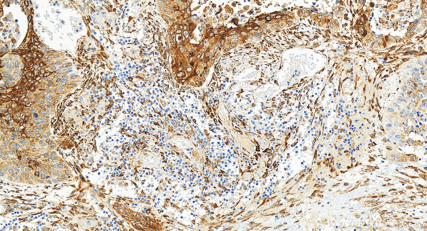 IHC staining of human cervical squamous cancer using 81805-1-RR
