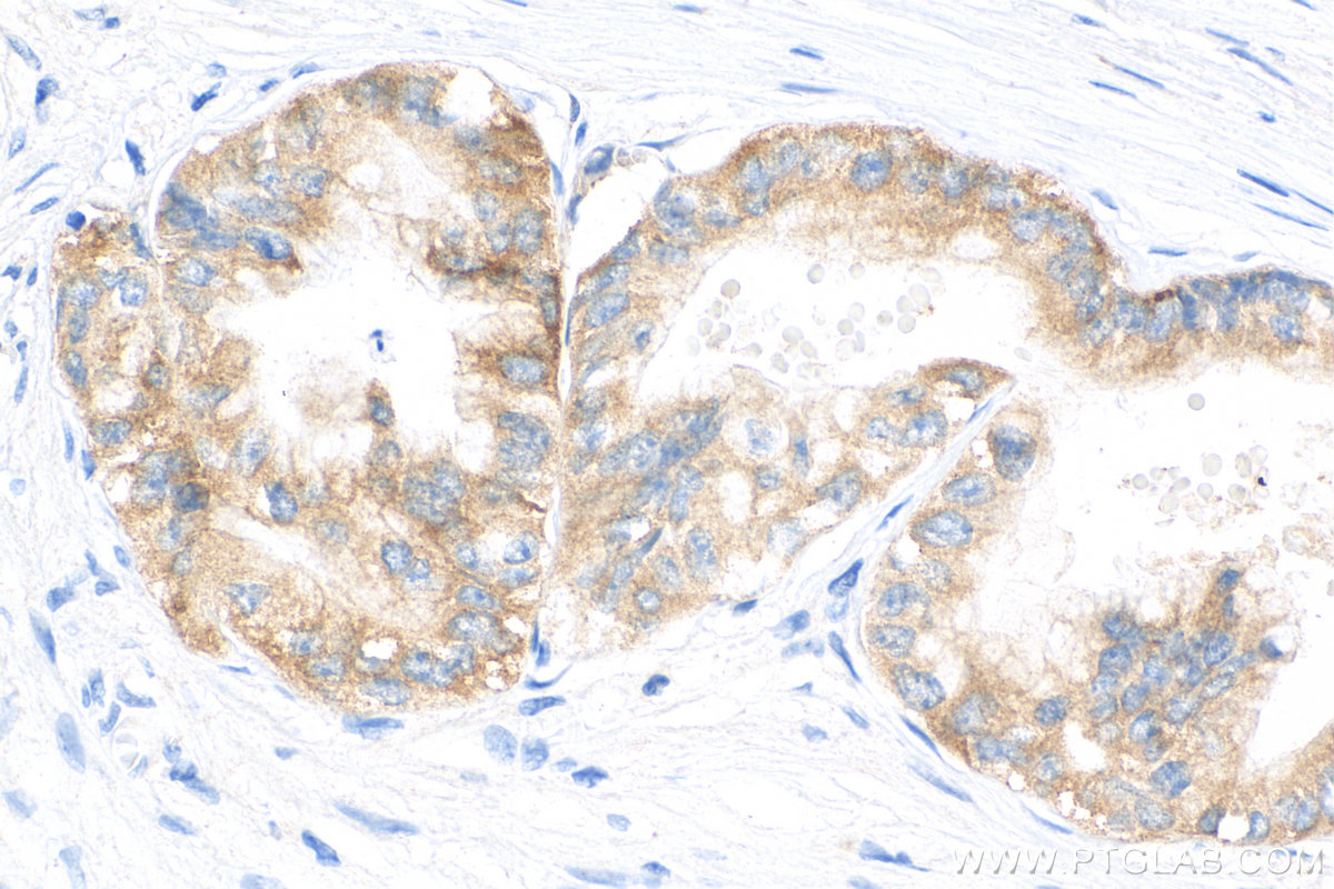 IHC staining of human pancreas cancer using 81805-1-RR