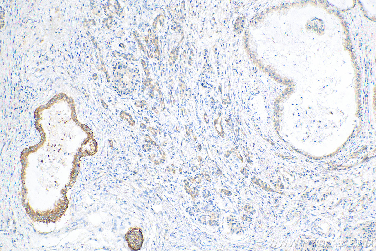 IHC staining of human pancreas cancer using 81805-1-RR