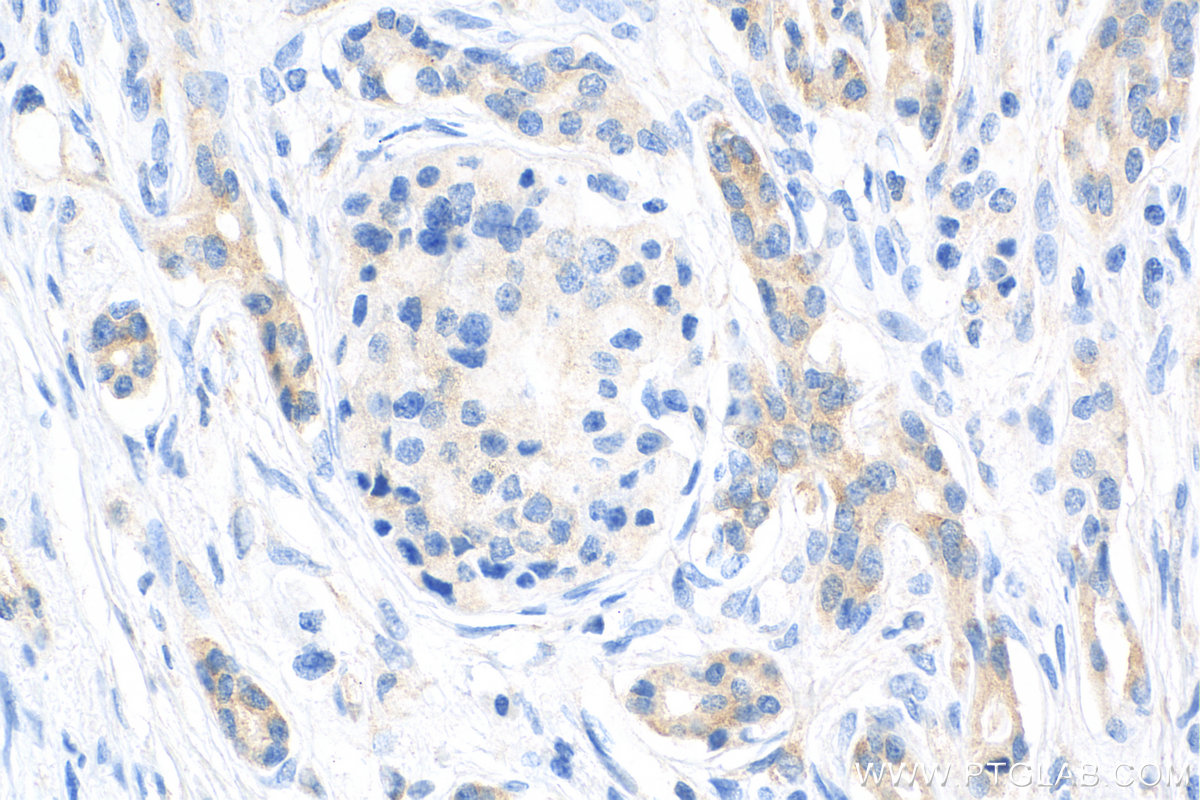 IHC staining of human pancreas cancer using 81805-1-RR