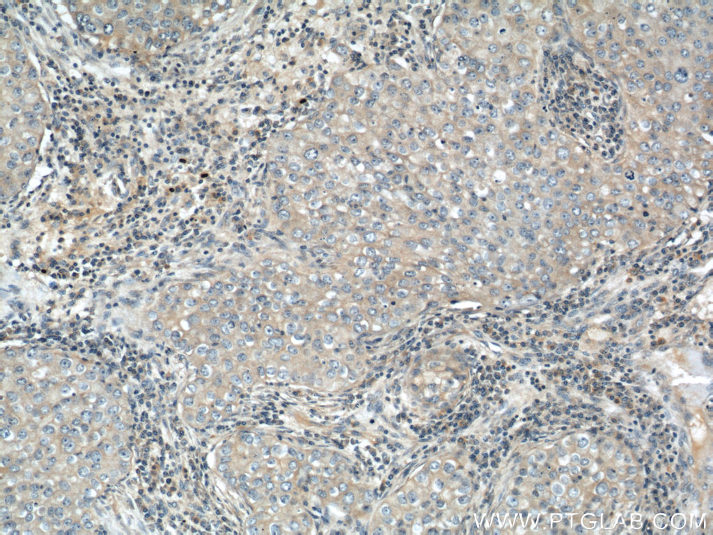 IHC staining of human breast cancer using 10189-2-AP