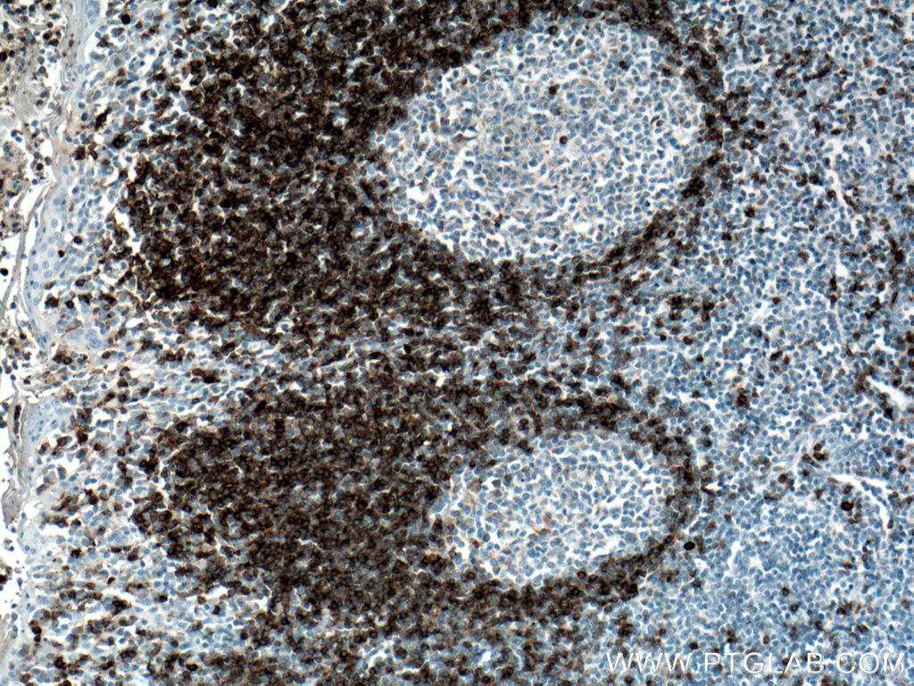 IHC staining of human tonsillitis using 16489-1-AP