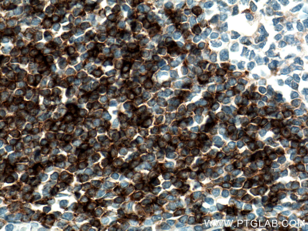 IHC staining of human tonsillitis using 16489-1-AP