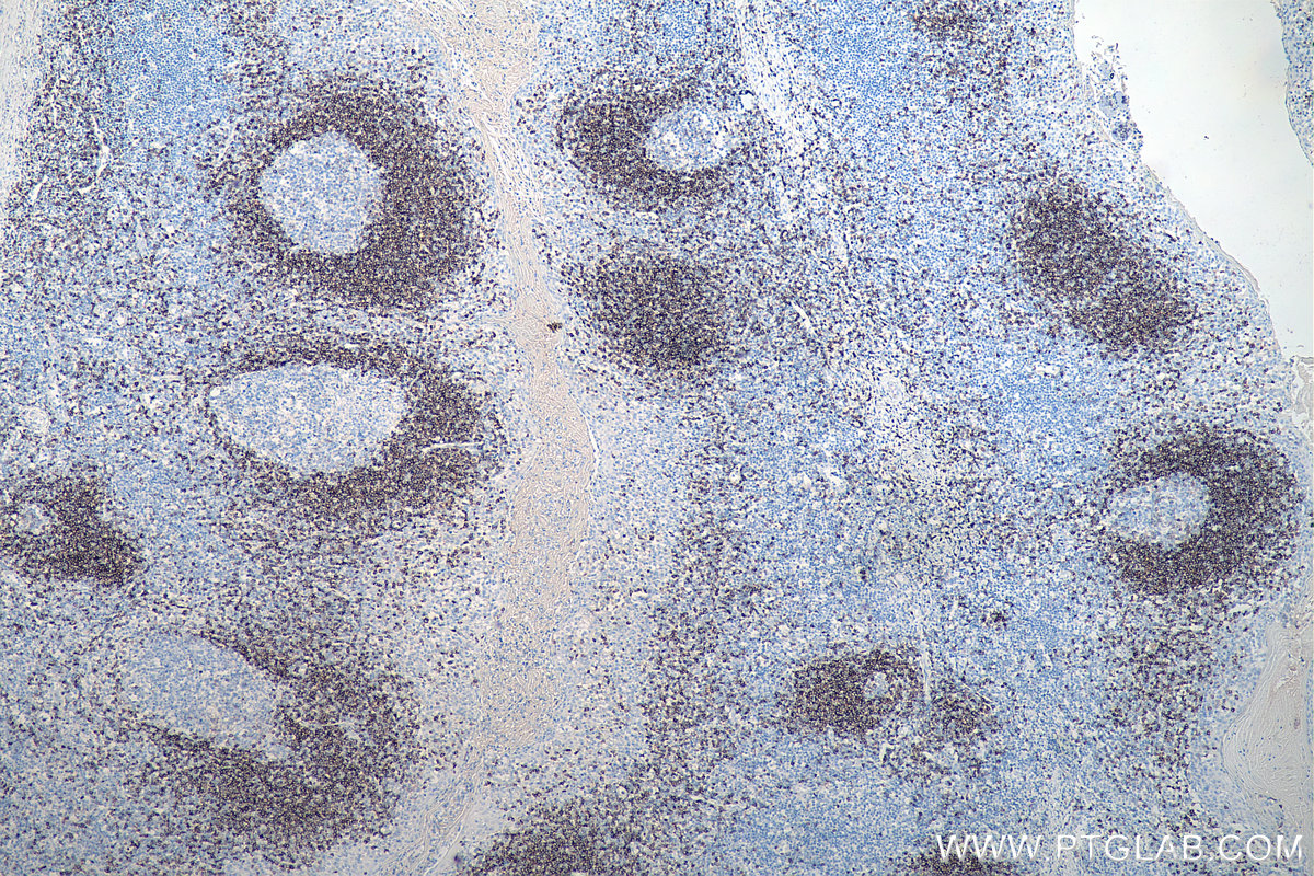 IHC staining of human tonsillitis using 67538-1-Ig