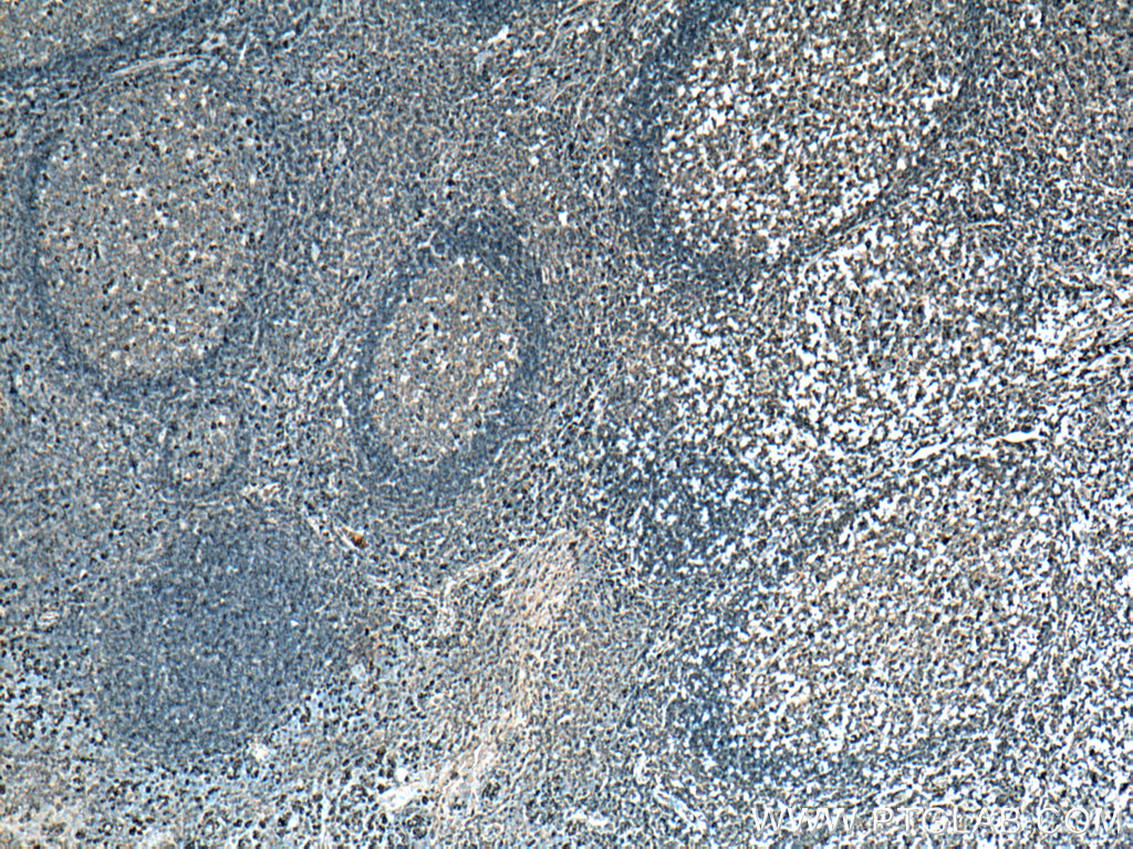 IHC staining of human tonsillitis using 16402-1-AP