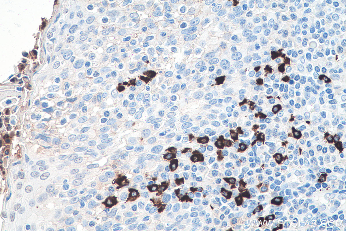 IHC staining of human tonsillitis using 66408-1-Ig
