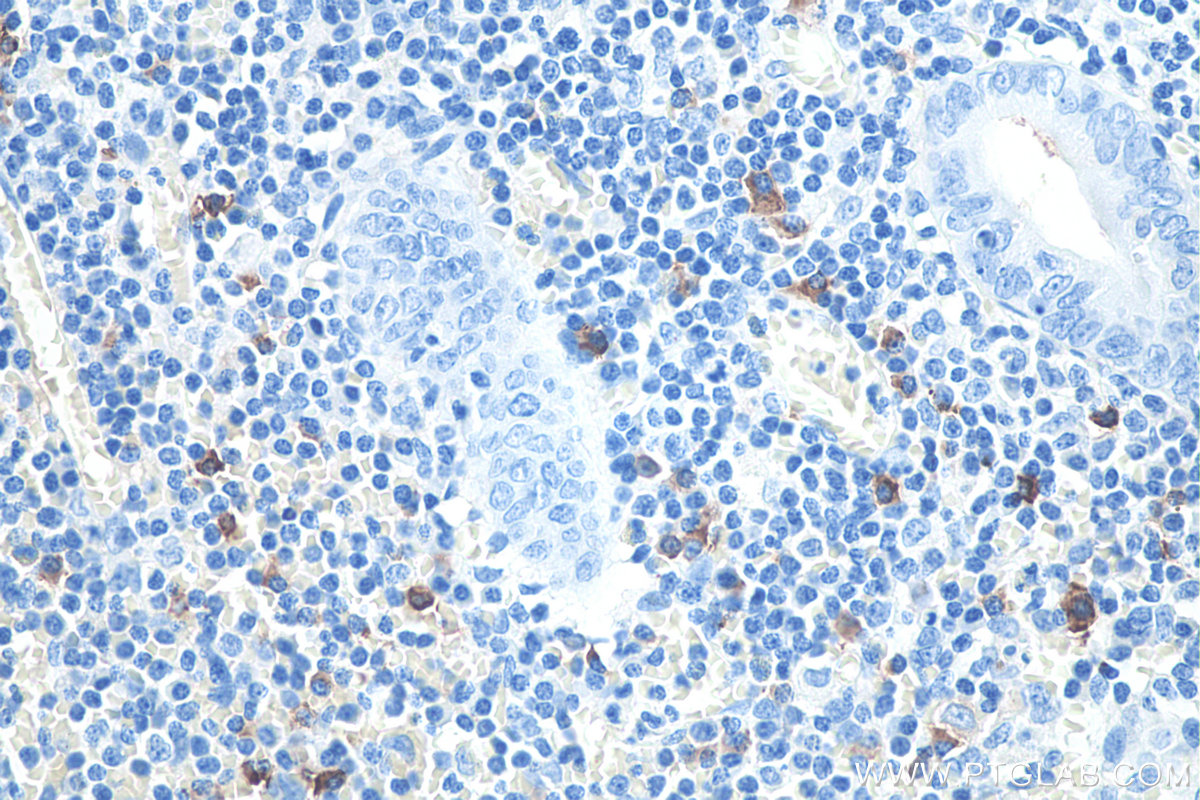 IHC staining of human appendicitis using 66408-1-Ig