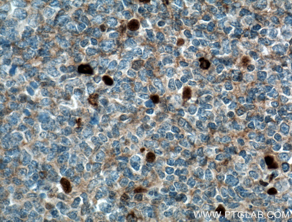 IHC staining of human tonsillitis using 11016-1-AP