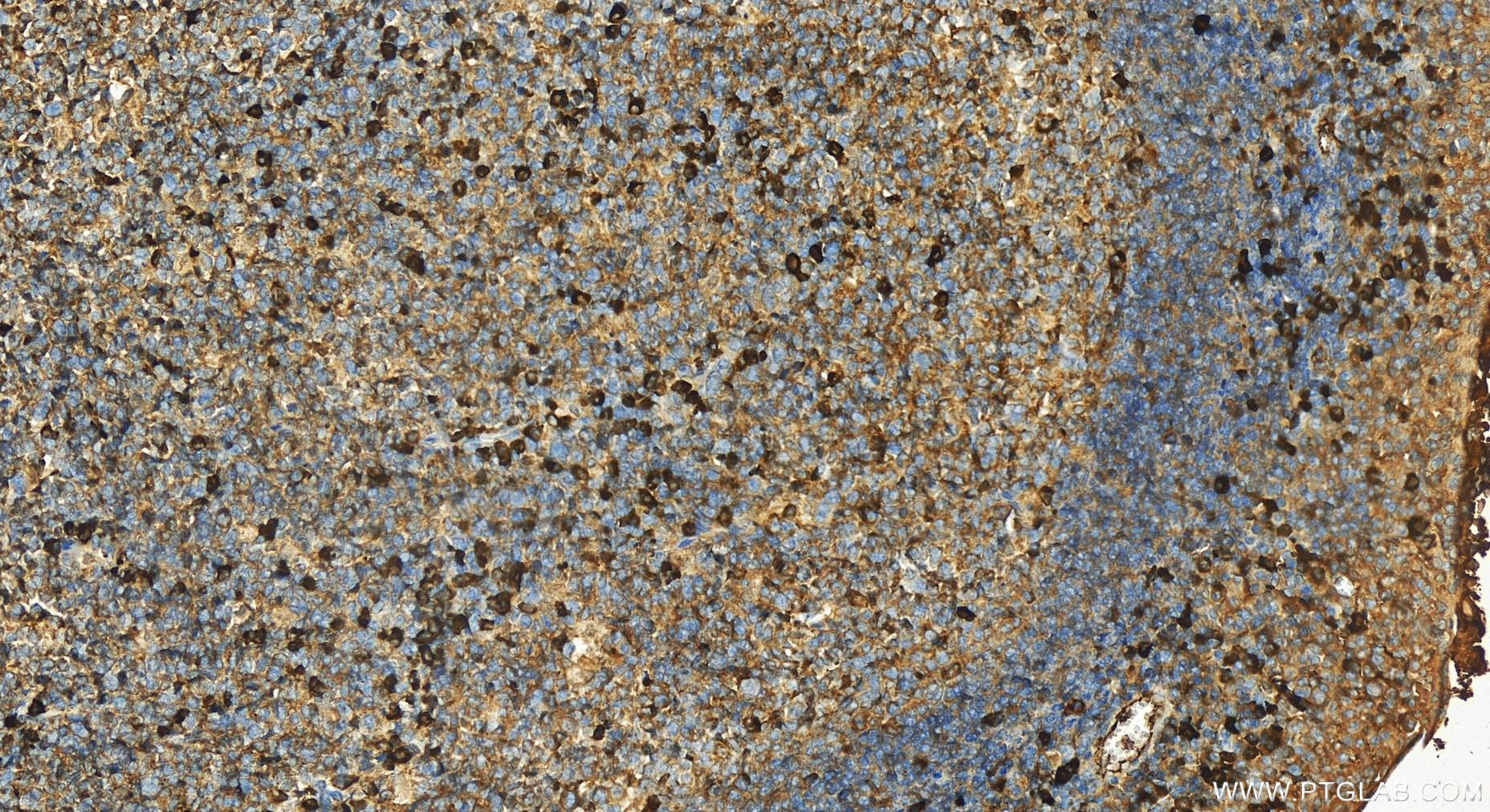 IHC staining of human tonsillitis using 13688-1-AP