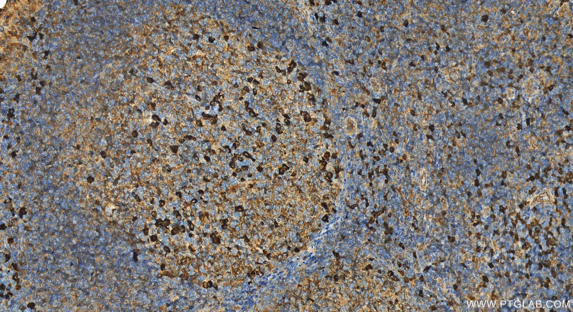 IHC staining of human tonsillitis using 13688-1-AP