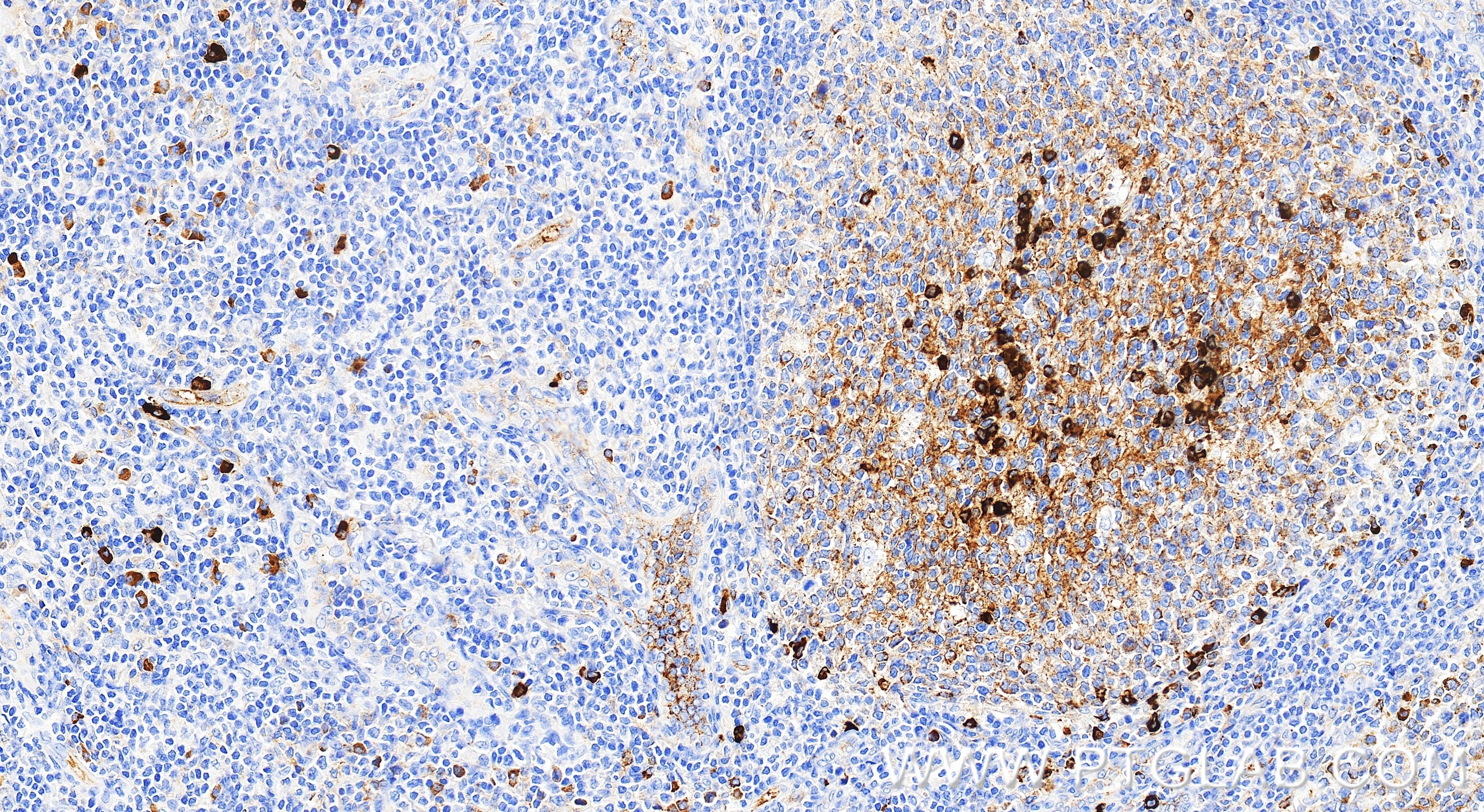 IHC staining of human tonsillitis using 86939-1-RR (same clone as 86939-1-PBS)