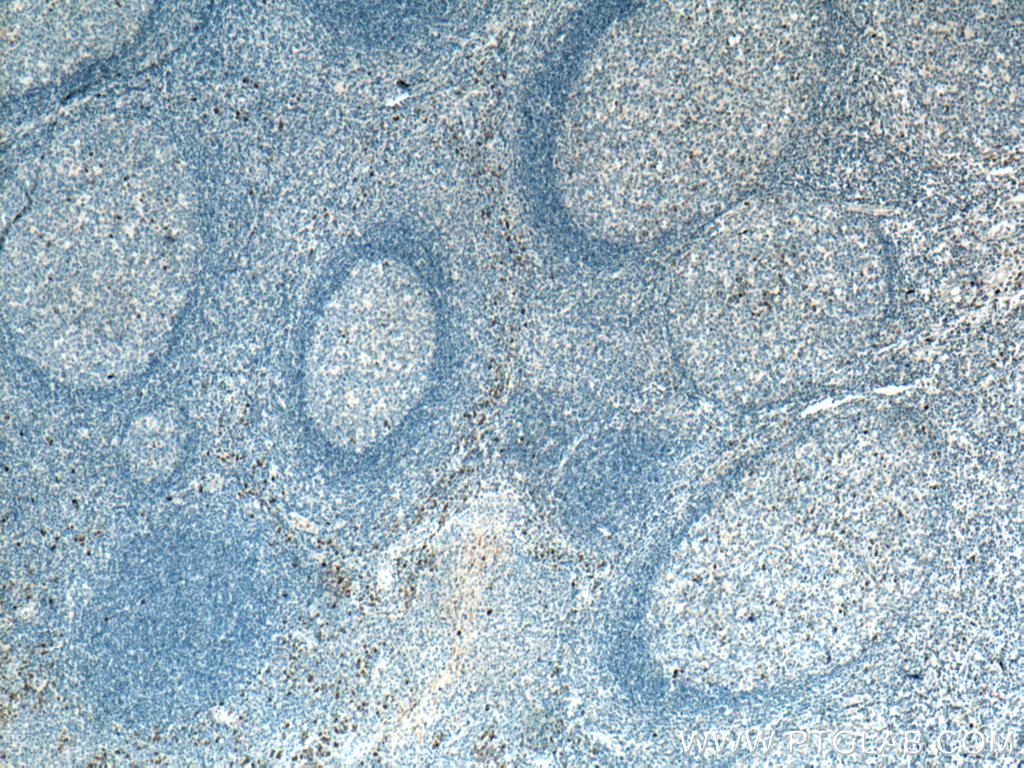 IHC staining of human tonsillitis using 11781-1-AP