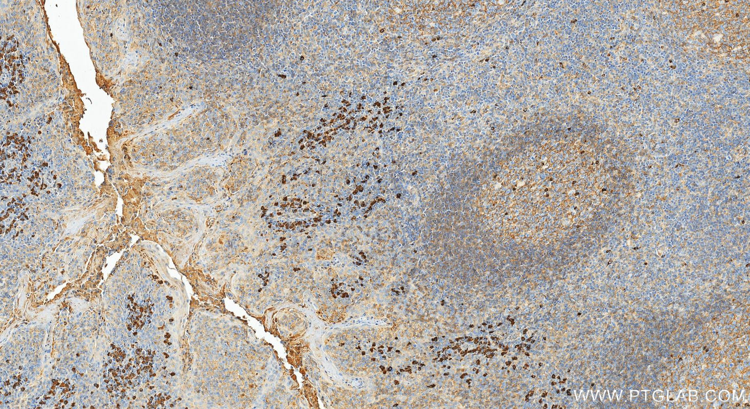 IHC staining of human tonsillitis using 11541-1-AP