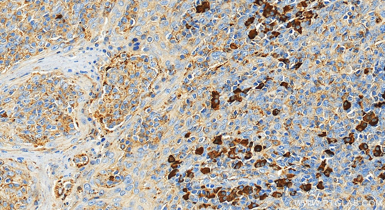 IHC staining of human tonsillitis using 11541-1-AP