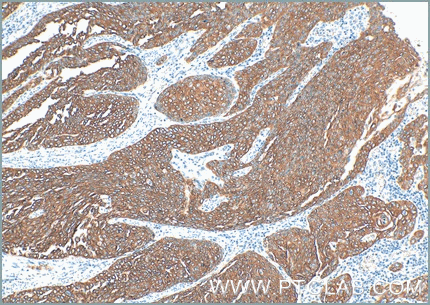 Immunohistochemical analysis of paraffin-embedded human oesophagus cancer tissue slide using anti-Cytokeratin 5 antibody (66727-1-Ig) labeled with FlexAble Biotin Antibody Labeling Kit for Mouse IgG1 (KFA027) and used at a dilution of 1:400 (under 10x lens & 40xlens). Streptavidin Poly-HRP and DAB substrate was used for detection. Heat mediated antigen retrieval performed with Tris-EDTA buffer (pH 9.0).