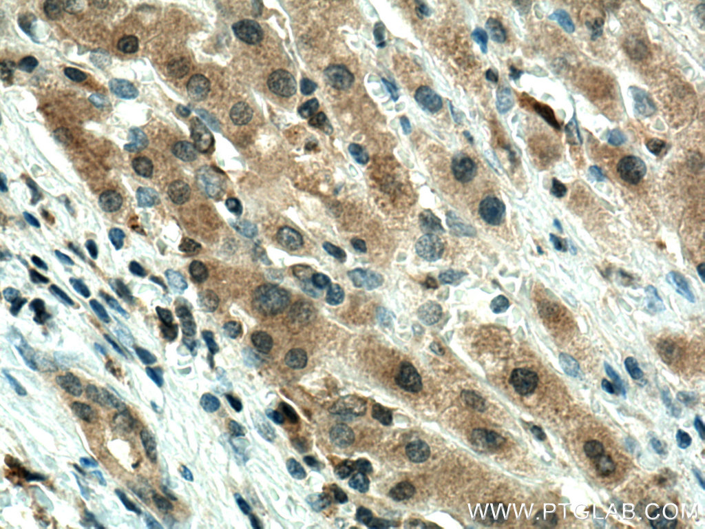 Immunohistochemical analysis of paraffin-embedded human liver cancer tissue slide using 67763-1-Ig (GPX4 antibody) at dilution of 1:2000 (under 40x lens). Heat mediated antigen retrieval with Tris-EDTA buffer (pH 9.0).