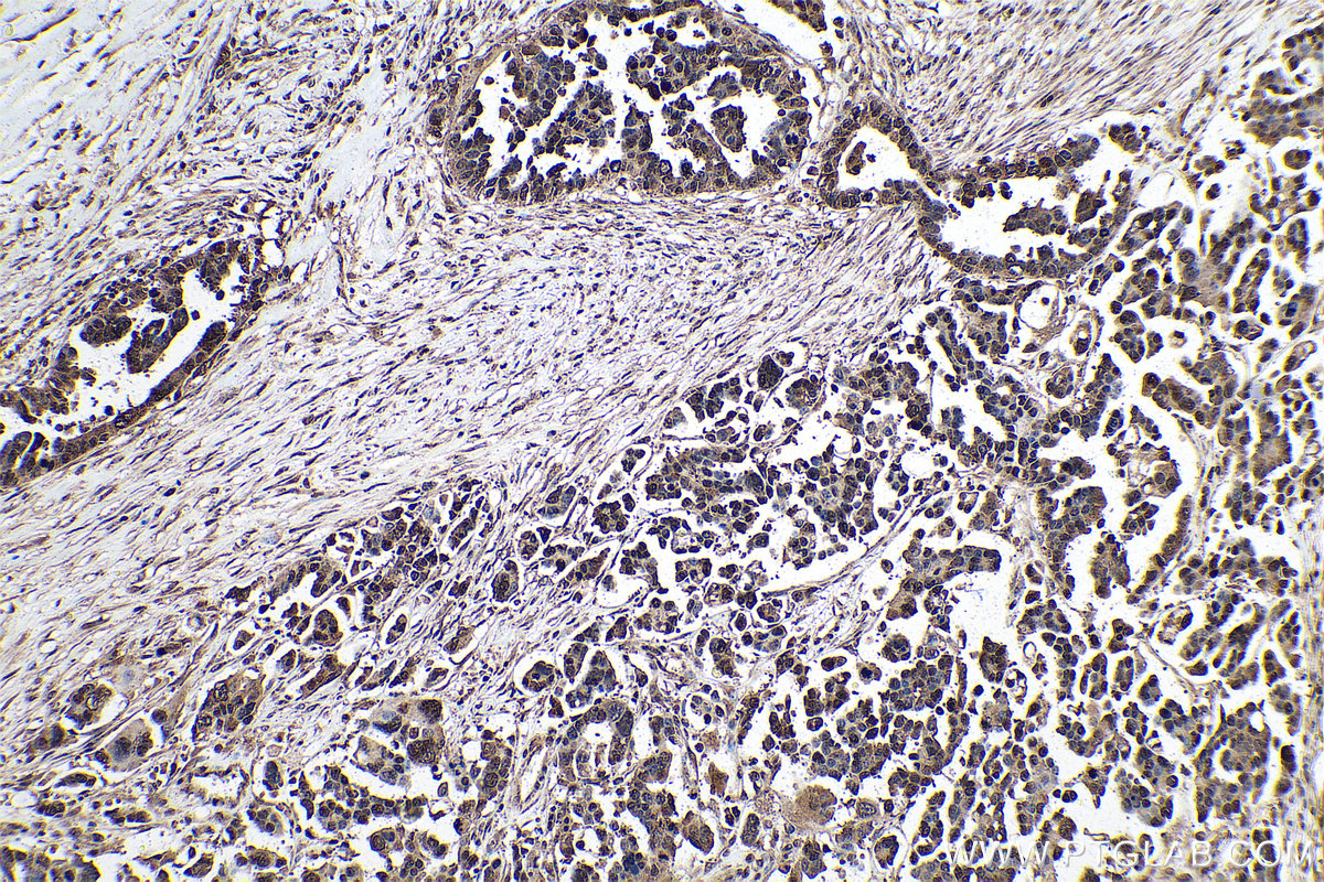 Immunohistochemical analysis of paraffin-embedded human colon cancer tissue slide using 68302-1-Ig (m7G antibody) at dilution of 1:2000 (under 10x lens). Heat mediated antigen retrieval with Tris-EDTA buffer (pH 9.0).